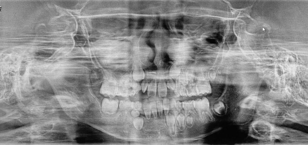 7-year-old-with-teeth-mobility-limited-mouth-opening-drbicuspid