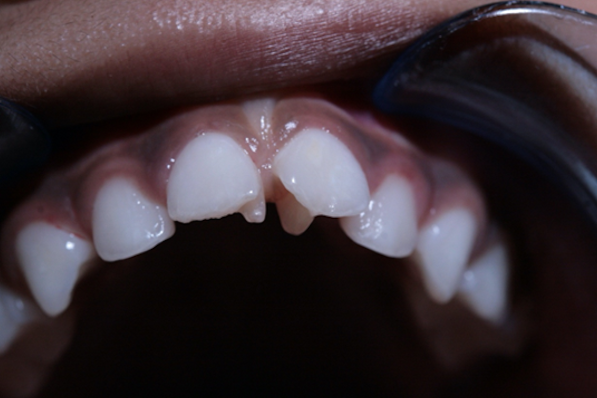 8yearold girl with an "extra" cusp DrBicuspid