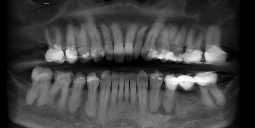 58-year-old-woman-with-a-radiographic-finding-drbicuspid